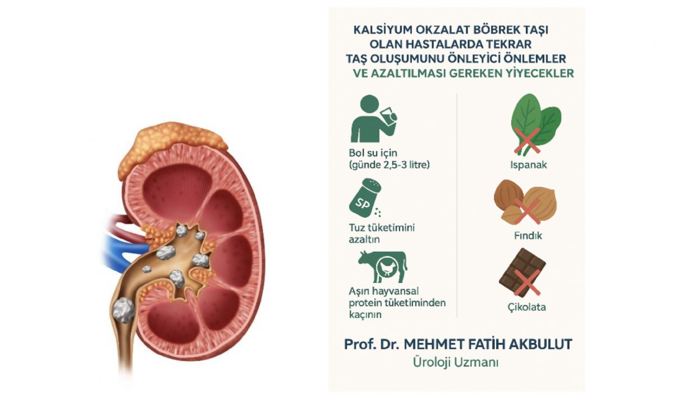 Böbrek Taşı (Kalsiyum Okzalat ) Olan Hastalarda Taş Oluşumunun Tekrarlamasını Önleyici Önlemler